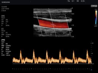 Common carotid artery, CFM & PW