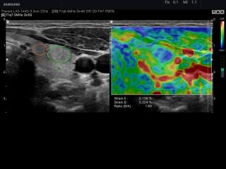 Thyroid, E-Strain™