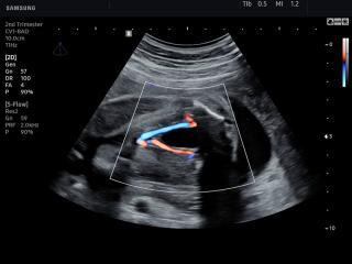 Umbilical artery, S-Flow