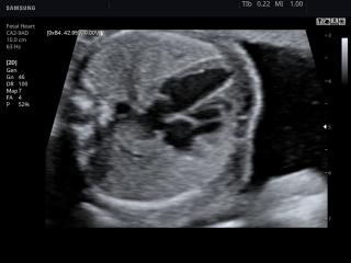 Fetal heart, B-mode