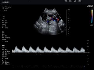 Umbilical cord, CFM & PW