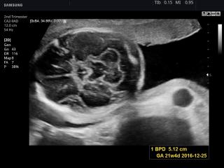 Fetal brain, B-mode