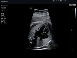 Fetal heart, B-mode