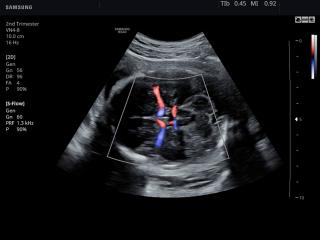 Fetal brain, S-Flow