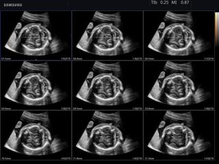 Fetal brain, MSV