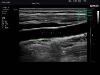 Common carotid artery, Auto IMT