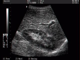 Umbilical artery, B-mode