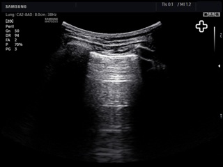 Lung (pleura), B-mode