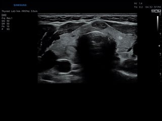 Thyroid, B-mode