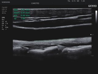 Common carotid artery, AutoIMT+