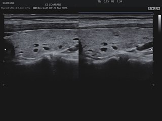 Thyroid, EzCompare