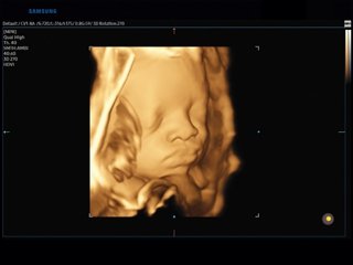 Fetal face, 3D