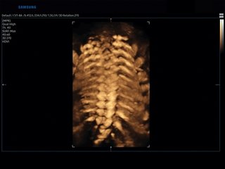 Fetal spine, 3D