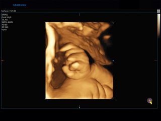 Fetal hand, 3D