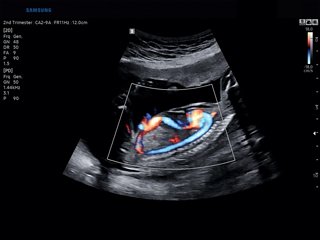 Fetal blood flow, S-Flow