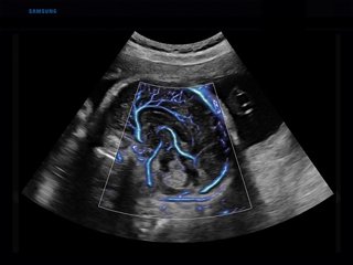 Fetal brain, MV-Flow