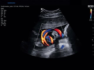 Umbilical cord, S-Flow + LumiFlow