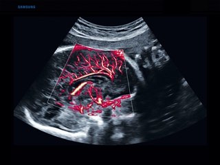 Fetal brain, MV-Flow + LumiFlow