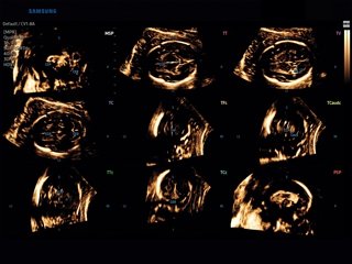 Fetal brain, 5D CNS+