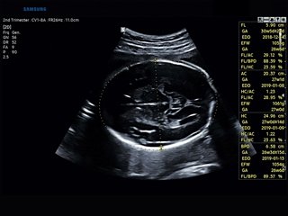 Fetus, BiometryAssist