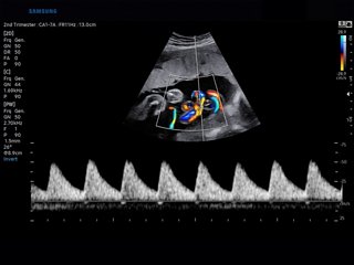 Umbilical cord, CFM & PW