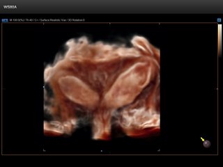 Bicornuate uterus, Crystal Vue, 3D