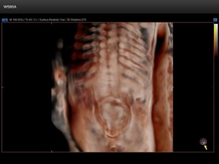 Spina bifida - defect of fetal`s development, 3D