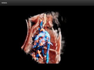 Fetal liver blood flow, Crystal Vue Flow, 3D
