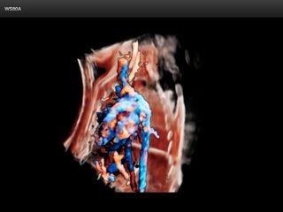 Fetal liver blood flow, Crystal Vue Flow