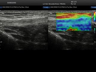 Patellar ligament, Elastoscan