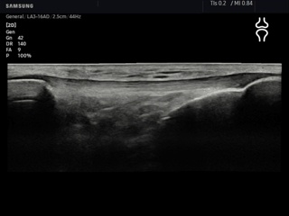 Patellar tendon, Panoramic