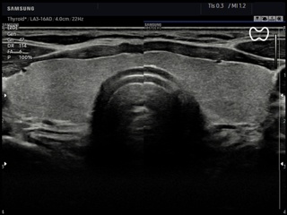 Thyroid, ClearVision