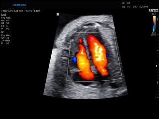 Fetal heart (4 chamber view), LumiFlow