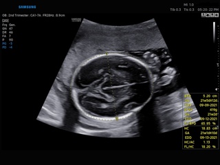 Fetus, BiometryAssist