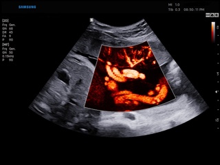 Umbilical vessels, MV-Flow