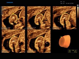 Fetus, 5D Limb Vol