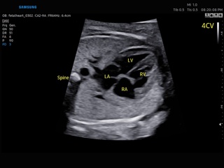 Fetal heart, ViewAssist