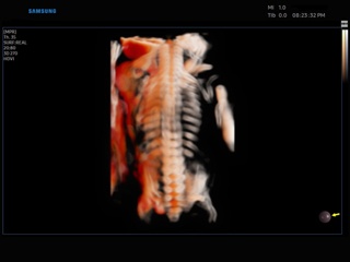 Fetal spine, CrystalVue, 3D