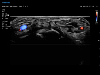 Finger flexor tendons, MV-Flow