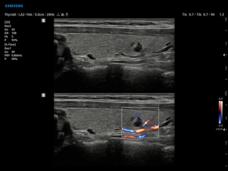 Thyroid - nodule, S-Flow