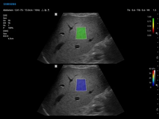 Liver, S-Shearwave