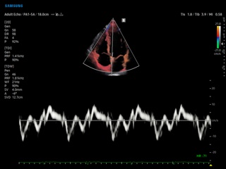 Heart, tissue doppler