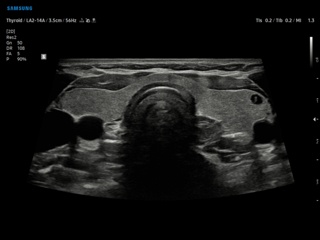 Thyroid, B-mode