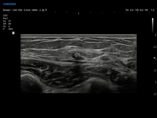 Breast - calcifications