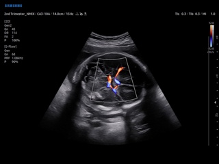 Fetal MCA, S-Flow