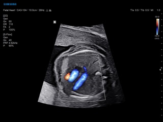 Fetal heart, S-Flow & LumiFlow