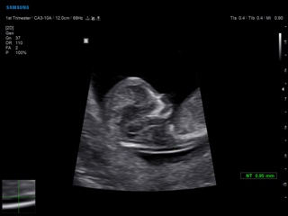 Fetus - NT measurement, BiometryAssist