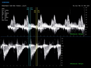 Fetal heart, RV MPI