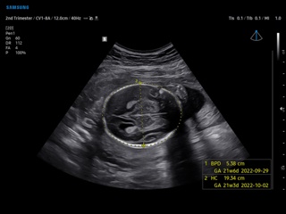 Fetal head, BiometryAssist