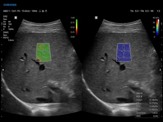 Liver, S-Shearwave